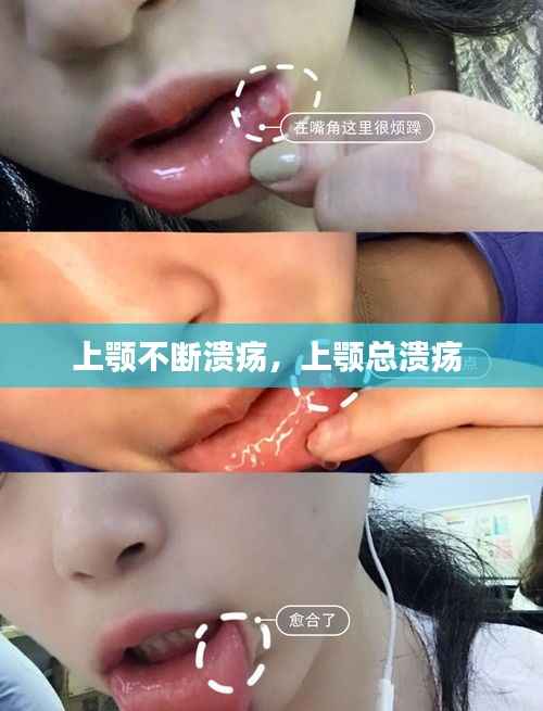 上颚不断溃疡，上颚总溃疡 